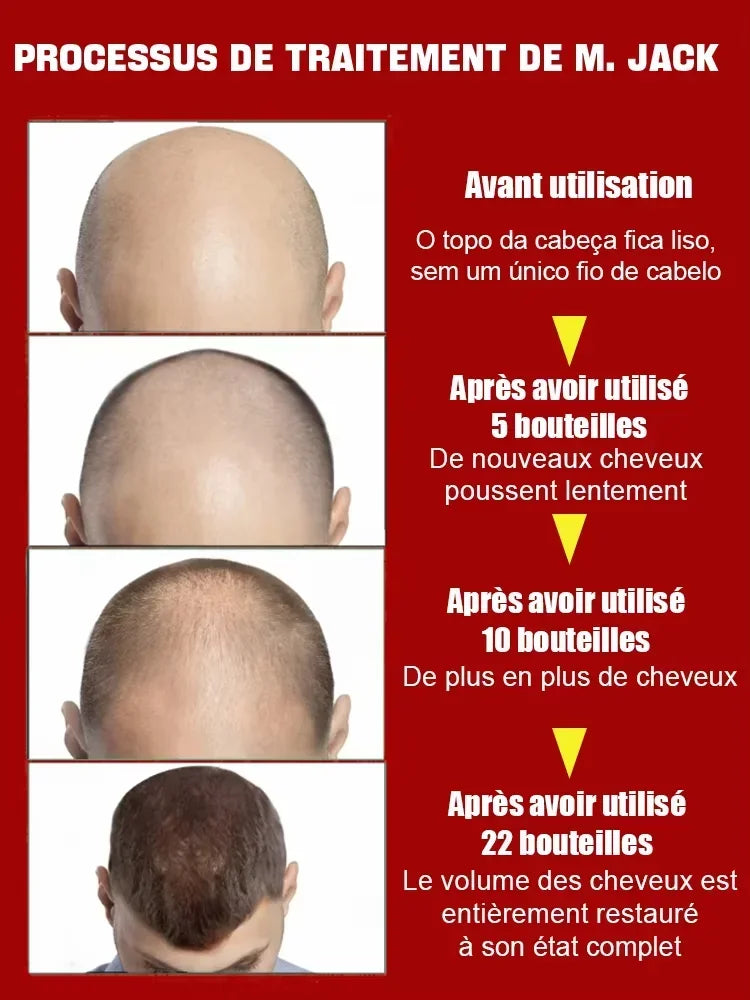 99% of buyers buy again, have more and more hair, say goodbye to baldness, thick hair,Hot selling product