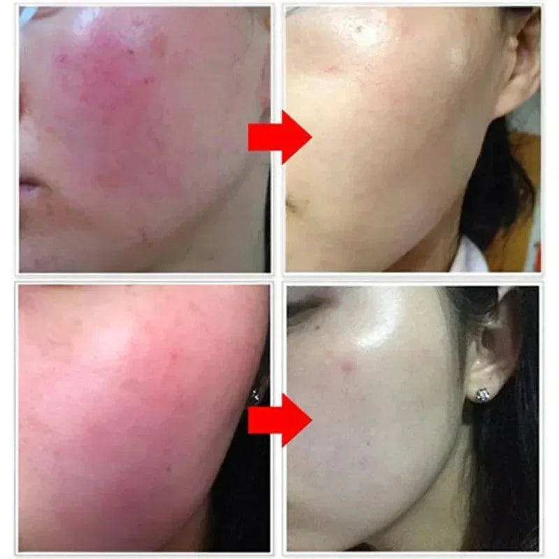 Facial Redness Repair Cream Improve Sensitive Skin Dryness Moisturizer Hydrating Sooth Lotion Removal Rosacea Korean Cosmetics